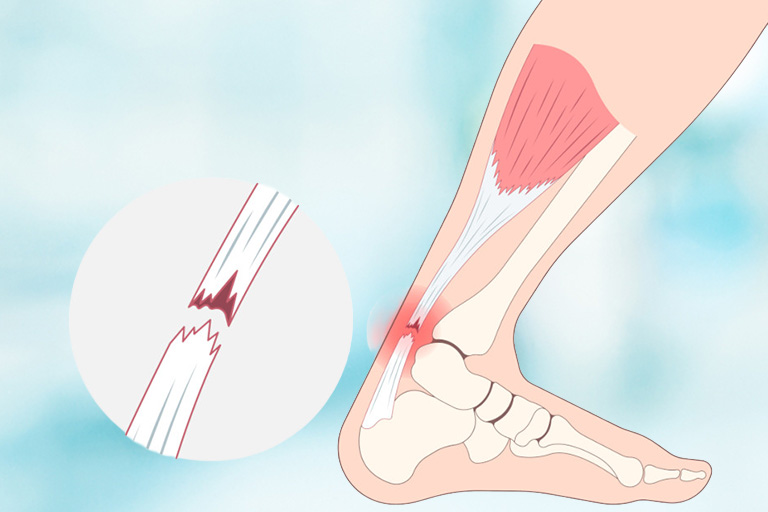 Achilles Tendon Tears & Ruptures