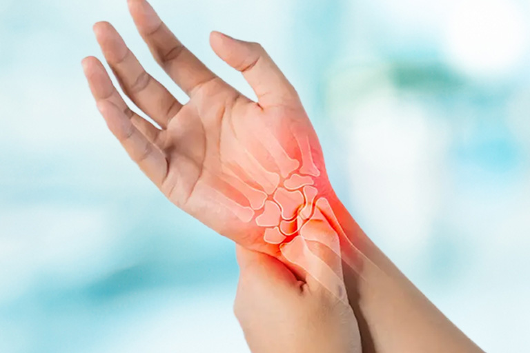 Carpal Tunnel Syndrome