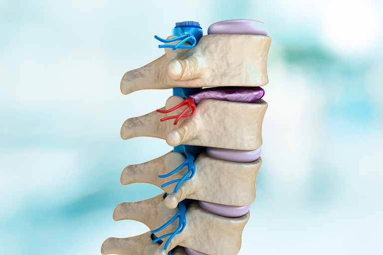 Degenerative Disc Disease