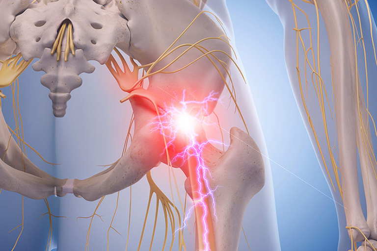 Sciatica & Pinched Nerves