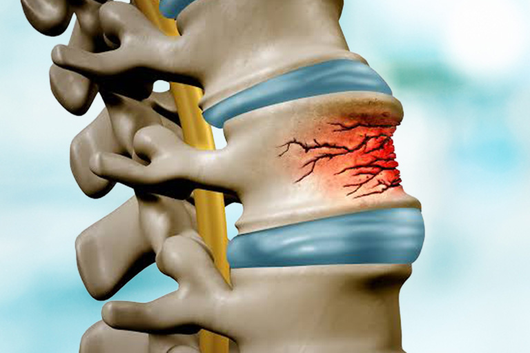 Spinal Fractures & Injuries